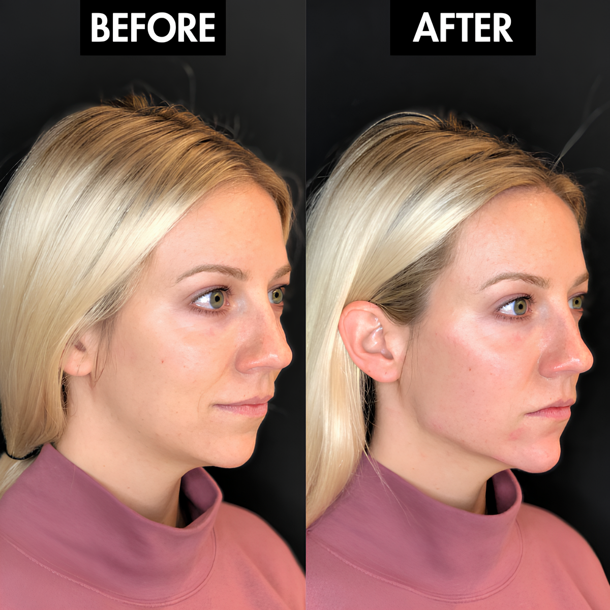 Lunoox™ Jaw & Chin Lifting Mask