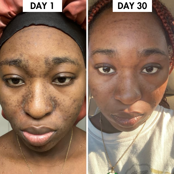 Lunoox™ Turmeric & Kojic Acid Soap Bar