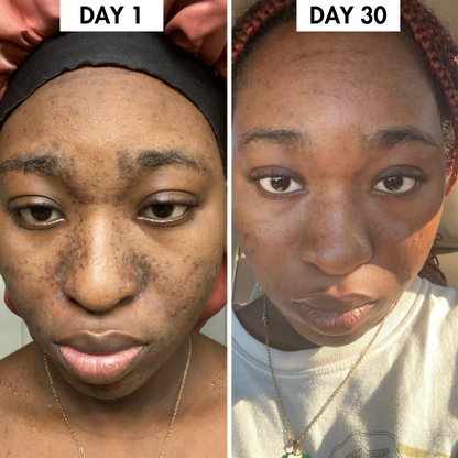 Lunoox™ Turmeric & Kojic Acid Soap Bar