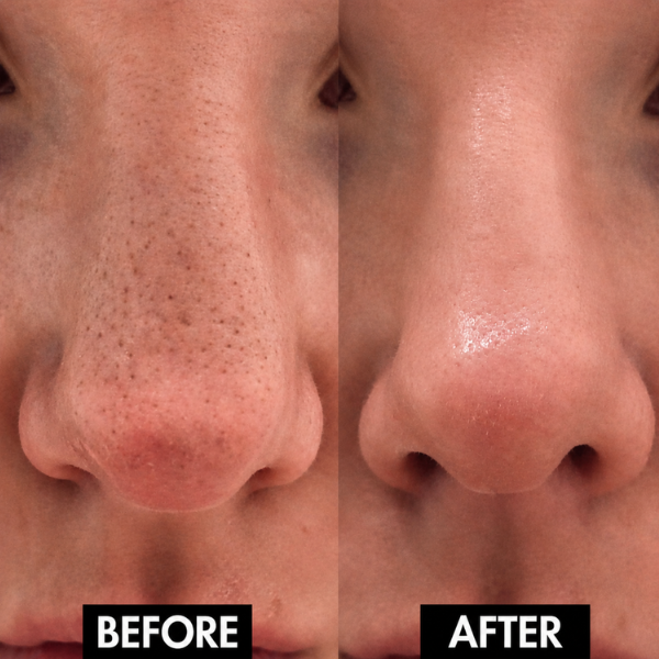Lunoox™ Electric Facial Pore Vacuum