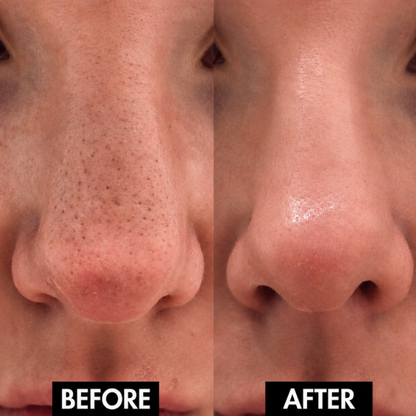 Lunoox™ Electric Facial Pore Vacuum